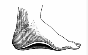 esempio di alterazione dell'arco del piede